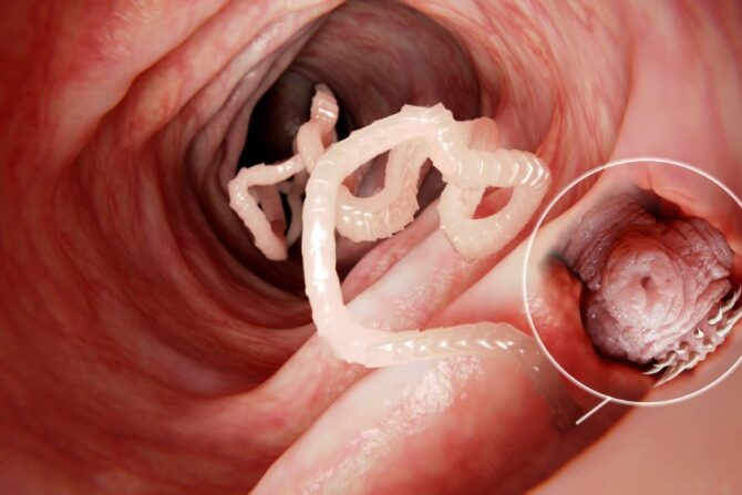 Tapeworm in Human Intestine with magnification of the head attached to the wall of the intestine